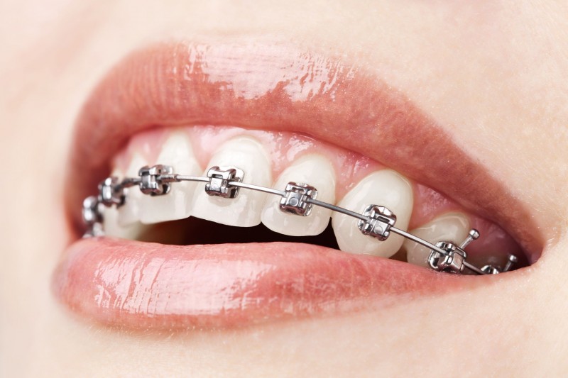 Learn About Components And How Braces Work In St. Augustine FL