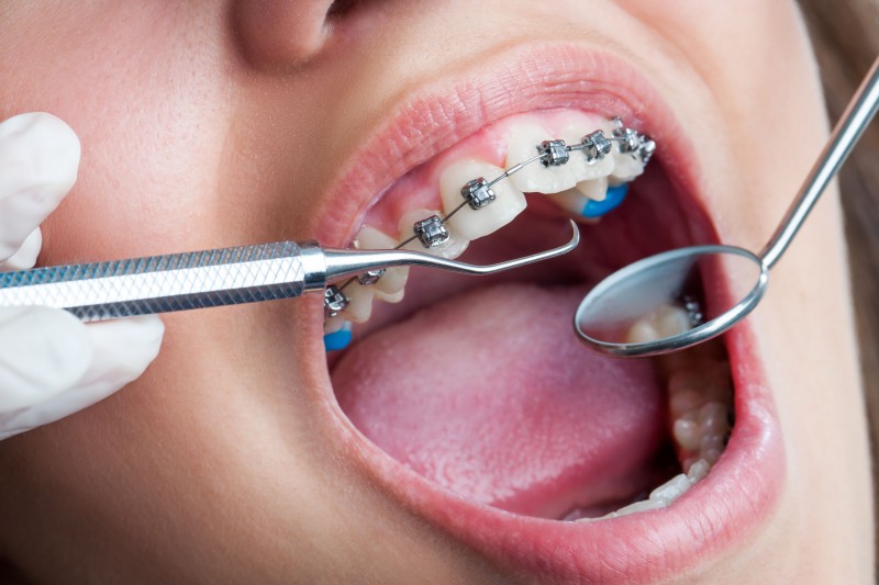 Benefits of Exploring Options for Orthodontic Care in Queens NY