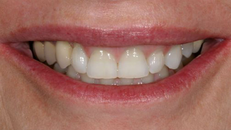 Achieve the Perfect Smile with These 4 Esthetic Dentistry Options