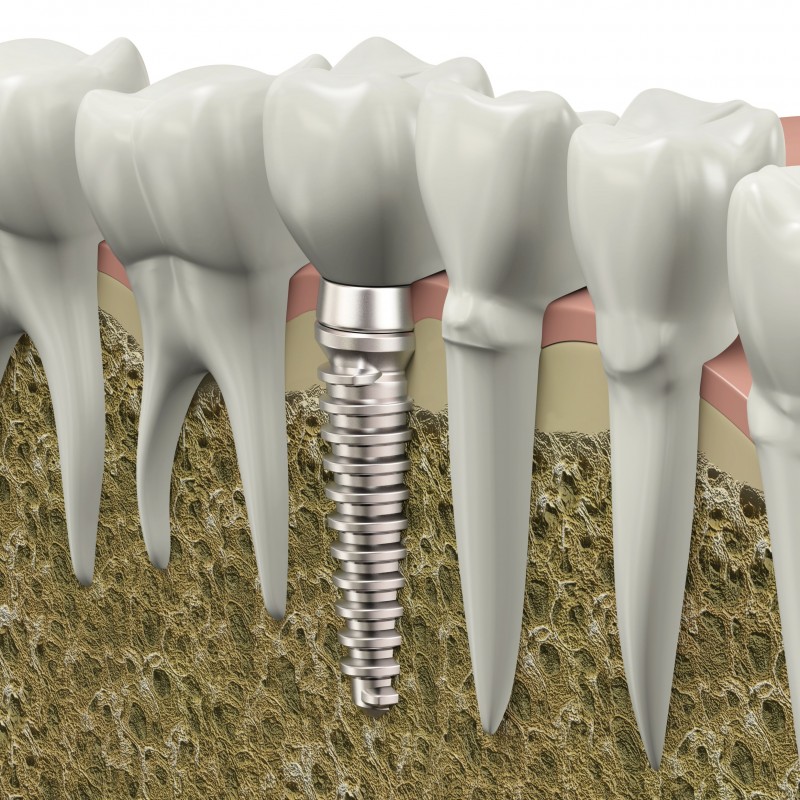 Why So Many Patients Opt for Implants in Waukesha WI