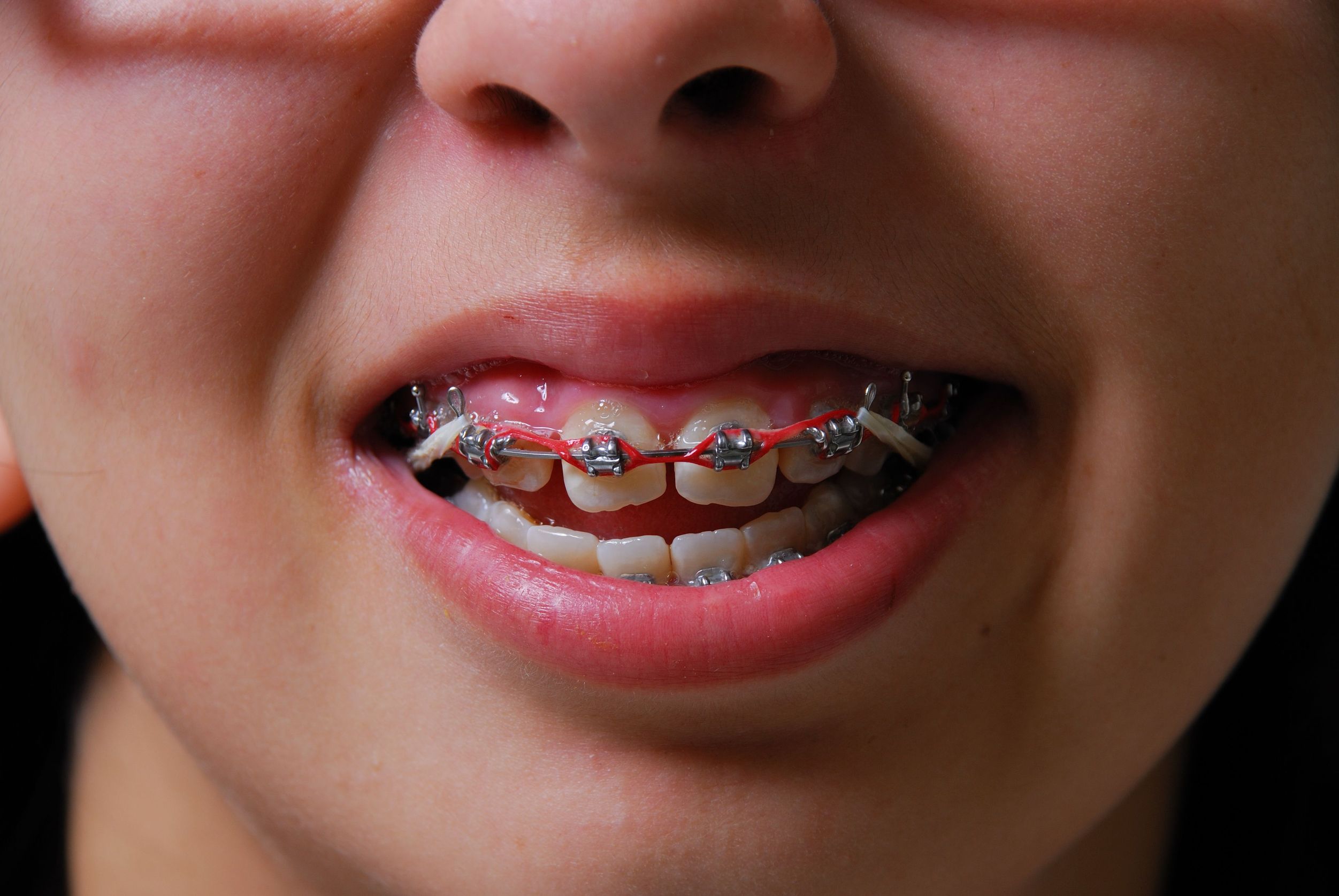 The Correct Way To Maintain Braces