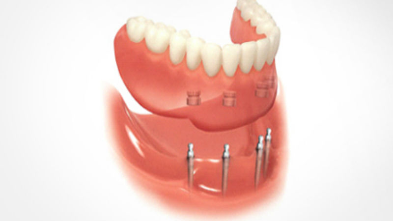 Dental Implant Services in New Iberia, LA Provide an Easy Way to Get Your Smile Back